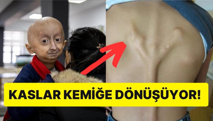 Muhtemelen Daha Önce Hiçbir Yerde Duymadığınız Akıllara Durgunluk Veren Nadir Hastalıklar